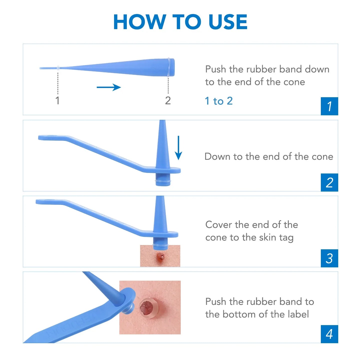 Home Skin Tag Removal Kit