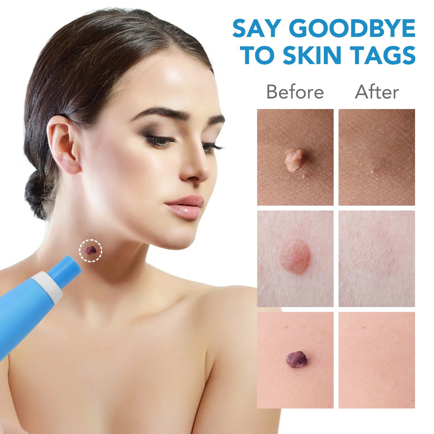 2-In-1 Automatic Skin Tag Remover Kit