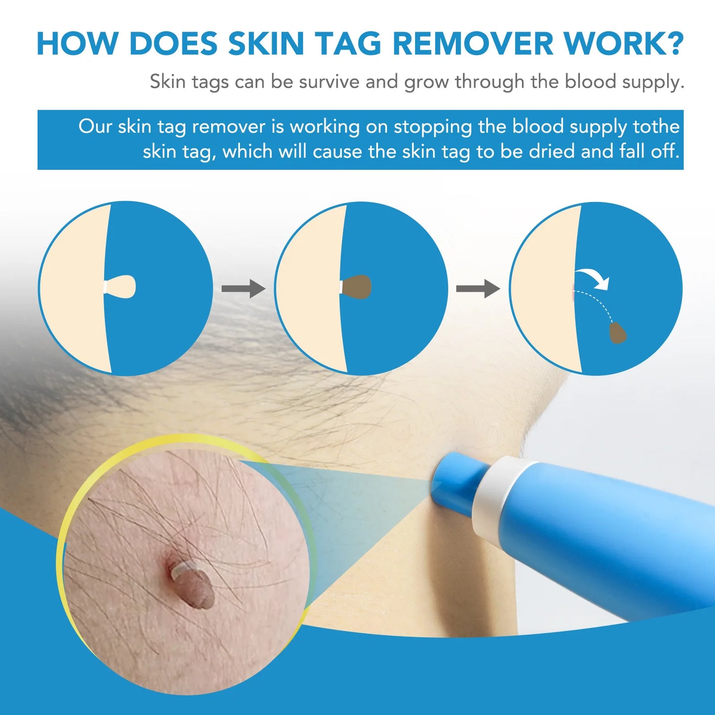 2-In-1 Automatic Skin Tag Remover Kit