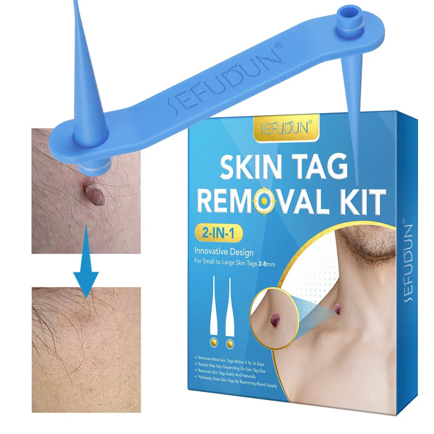 Home Skin Tag Removal Kit